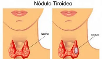   Nódulos tiroideos dificultan el control glucémico   