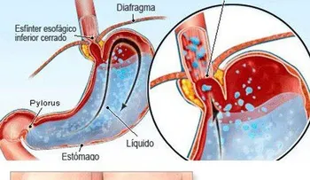 Pautas nutricionales que debes seguir para el reflujo gastroesofágico