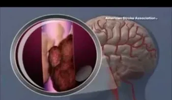 Accidente cerebrovascular (VIDEO)