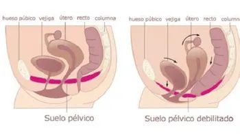 Suelo pélvico débil y 7 ejercicios simples para fortalecerlo