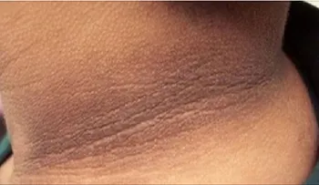 2 Eficaces remedios caseros para tratar el cuello oscuro