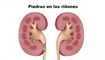 Jarabe potente para eliminar las piedras en los riñones