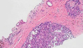 Esto influye sobre tasas de biopsia y complicaciones relacionadas