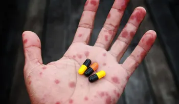 Vuelve la fiebre escarlata