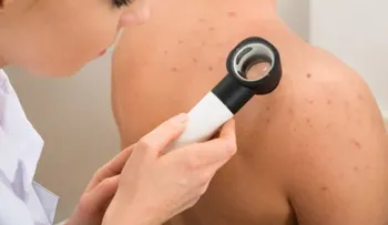 ¿Tienes acné en la espalda? Aprende a lidiar con este problema
