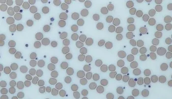 El exceso de plaquetas en sangre podría alertar de la presencia de un cáncer