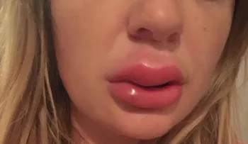 Jessica Bennett, compartió un video mostrando pus de sus labios infectados por un relleno â??baratoâ??