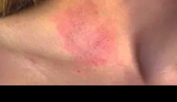 Alergias (VIDEO)