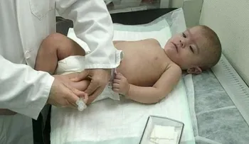 Sarampión deja sin memoria al sistema inmune durante tres años