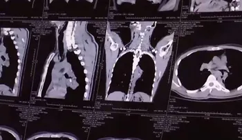 Tenía 20 años con ataques de tos, lo operaron y descubrieron un insólito objeto en sus pulmones
