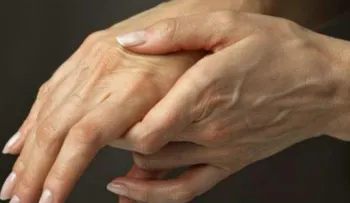 Cómo vencer la artritis reumatoide y no decaer en el intento