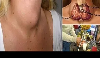 Así se cura las tiroide con tan solo este remedio