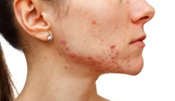 10 síntomas de desequilibrio hormonal que debes atender 