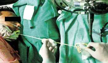 Médicos retiran una lombriz de casi dos metros del estómago de un hombre
