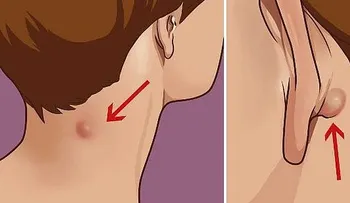 ¿Si tienes una protuberancia en el cuello, la espalda o detrás de la oreja?: Aquí está lo que necesita saber... 