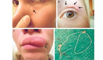 Estas selfies muestran el bulto que se movía en la cara de una mujer: era un gusano