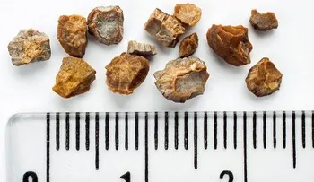 Trata las piedras en los riñones con vinagre de manzana