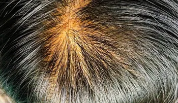 Remedio para combatir el exceso de sebo en el pelo y evitar su caída