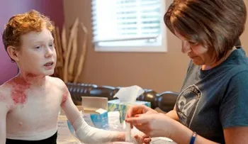  Reconstruyen 80 por ciento de la piel de un niño con una técnica genética 