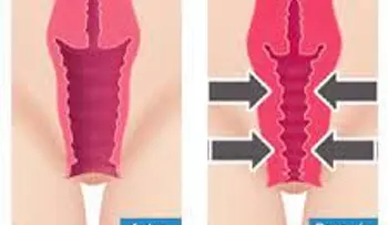 Un remedio imperdible para estrechar la vagina; mejor que una cirugía