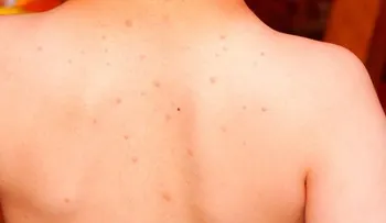 La varicela en los niños sus causas y tratamiento natural