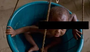 Nueve de cada 100 niños menores de 5 años en RD sufre desnutrición  