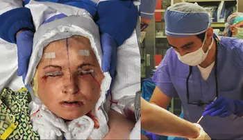 El cirujano que participó en trasplante de rostro a la paciente más joven del mundo, revela detalles de la operación