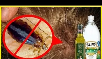 Muy efectiva y económica forma de quitarse los piojos que los médicos no te dirán (VIDEO)