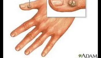 Anota: Como eliminar verrugas de una forma NATURAL!