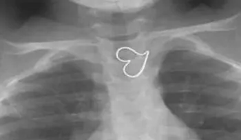 Caso de niña con dos corazones en el pecho causa asombro de doctores 
