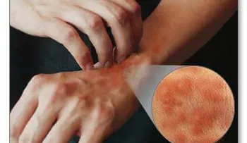 Síntomas de la alergia al látex