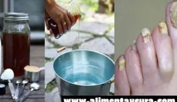 Elimina los hongos de tu cuerpo con este poderoso tónico casero