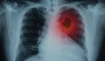  Los pulmones son la vida del sistema respiratorio: ¿Cómo se produce el cáncer?