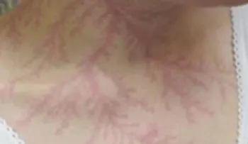 El misterio de la fibromialgia se resuelve al fin! 