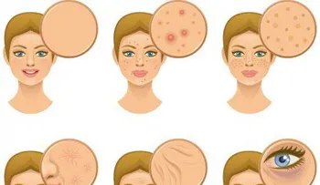 Causas de la piel seca y el acné en el rostro