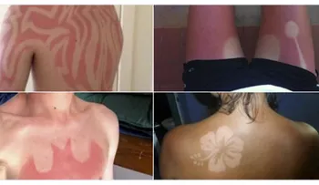 6 remedios de la abuela para curar las quemaduras solares