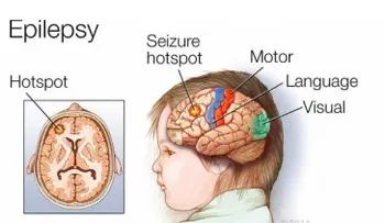 ¿La epilepsia no dura toda la vida en algunas personas?