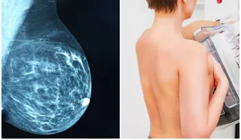 Estudian 629.000 mamografías para ver qué tumores se pueden malignizar