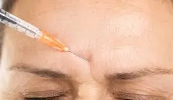 Botox: ¿Qué es, cómo funciona y cuáles son sus mitos y verdades?