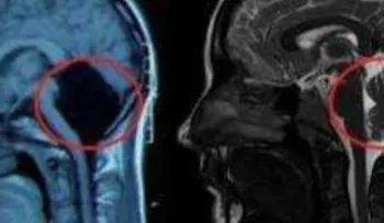 La joven china que probó que se puede vivir sin cerebelo.