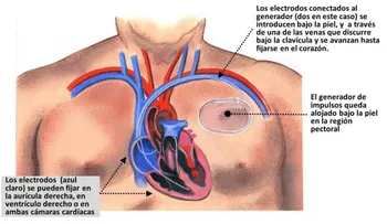 Cecanot realizará jornada gratuita de implantes de marcapasos y cateterismos