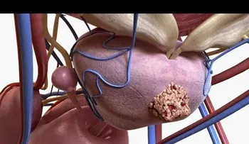 Los 4 mejores remedios naturales para desinflamar la Prostata