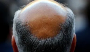 Científicos descubren medicamento combate las canas y pérdida de cabello, y dietas altas en grasa y colesterol