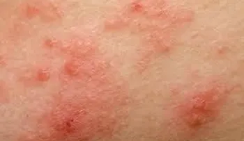 Especialista advierte sobre aumento de dermatitis atópica