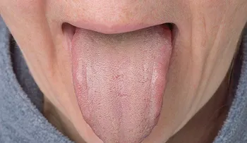 Lengua blanca, cuáles son sus causas y los mejores remedios para tratarla