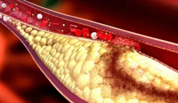EEUU analiza sangre que evalúa riesgo ataque cardíaco mediante ceramidas en el plasma