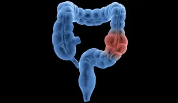 Las pruebas del cáncer de colón deberían empezar a los 45 años, dice nueva pauta