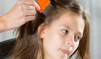Métodos naturales contra los piojos y liendres.