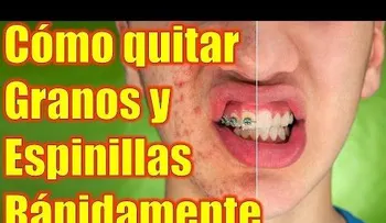 Anota los mejores mejores Remedios Caseros para quitar el Acné (Granos y Espinillas)