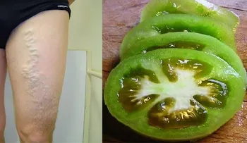 Tomates verdes y rojos para curar las venas varicosas 